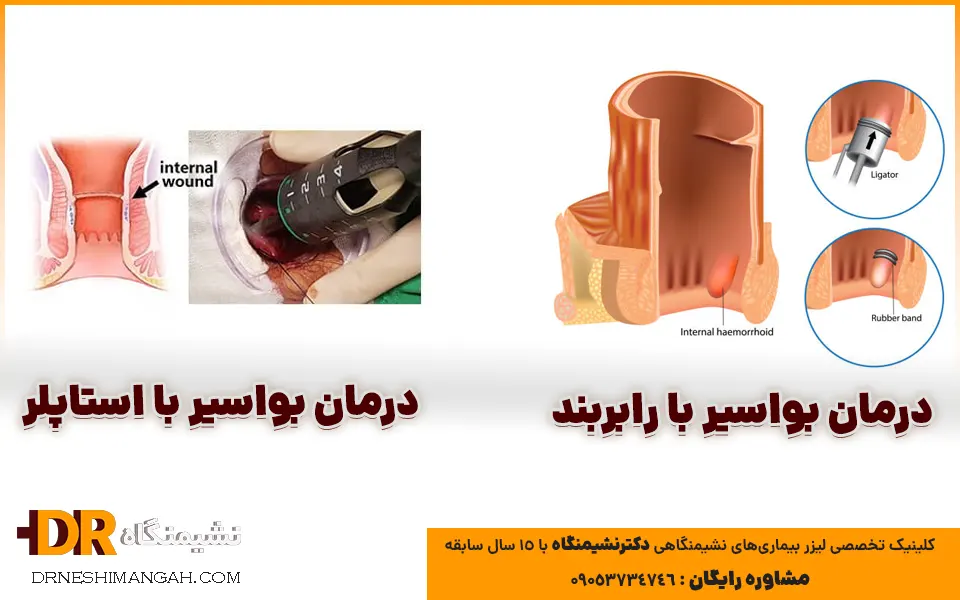 درمان بواسیر با استاپلر برای هموروئیدهای داخلی